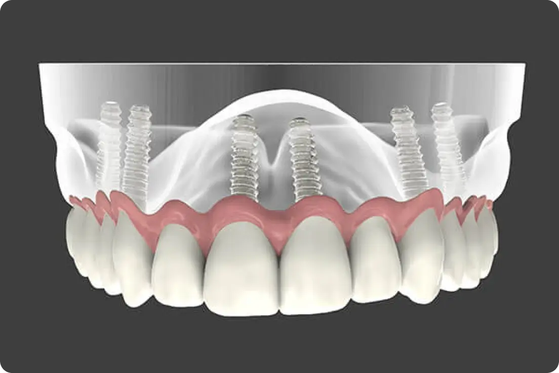 Secure, Comfortable Denture Solutions with Dental Implants