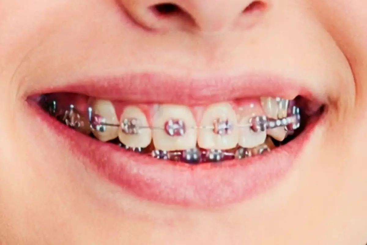 Metal Braces