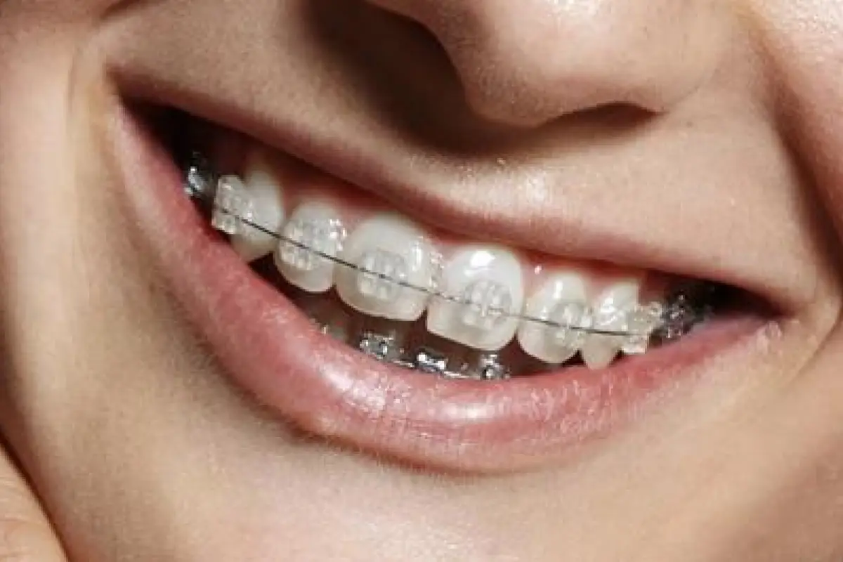 Clear Brackets