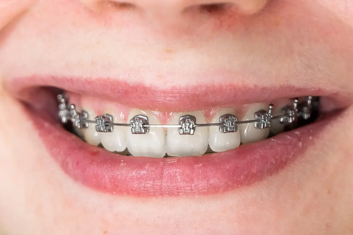 Self-Ligating Braces