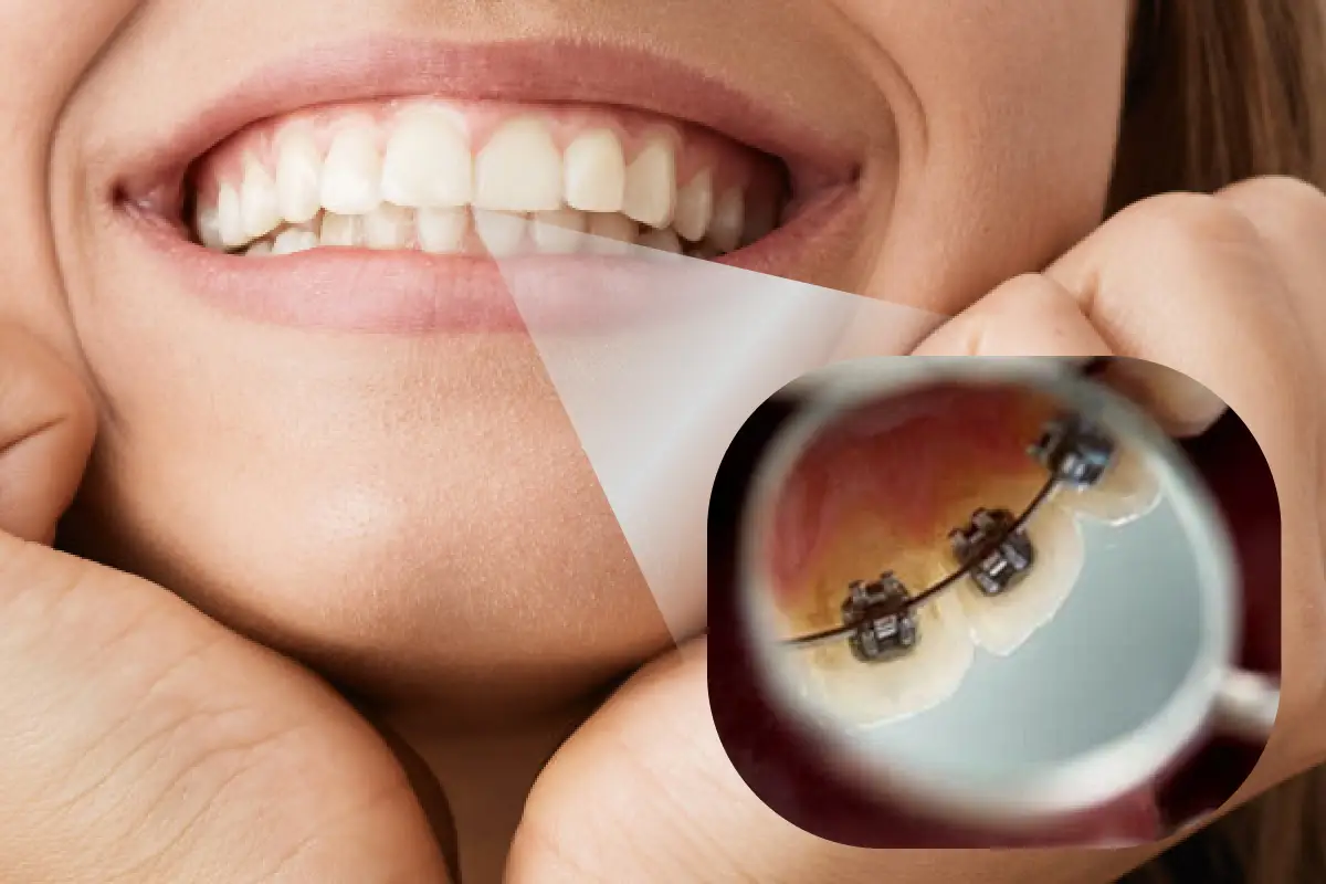 Lingual Braces