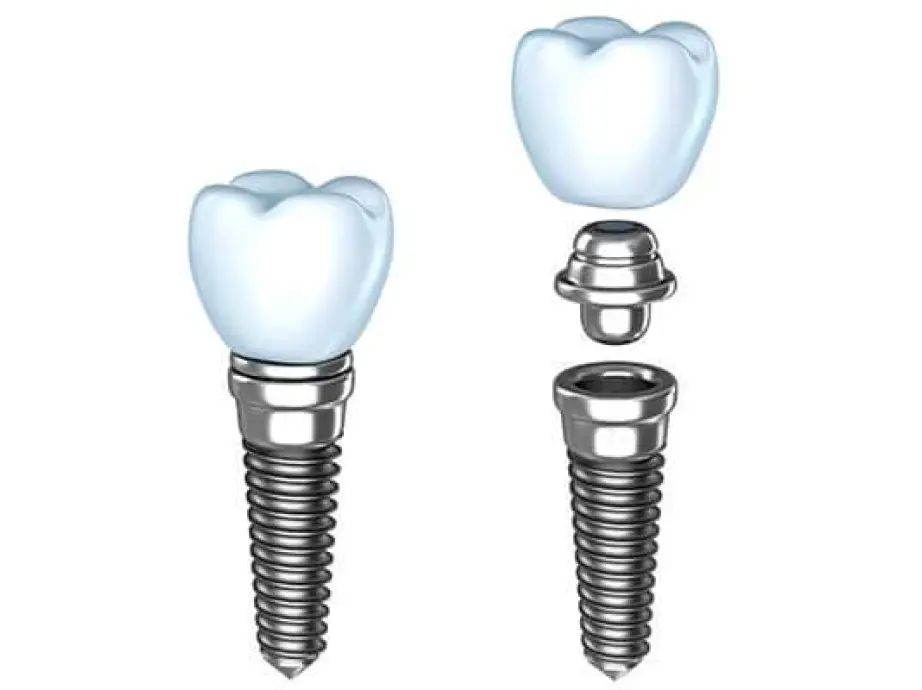 Dental Implants