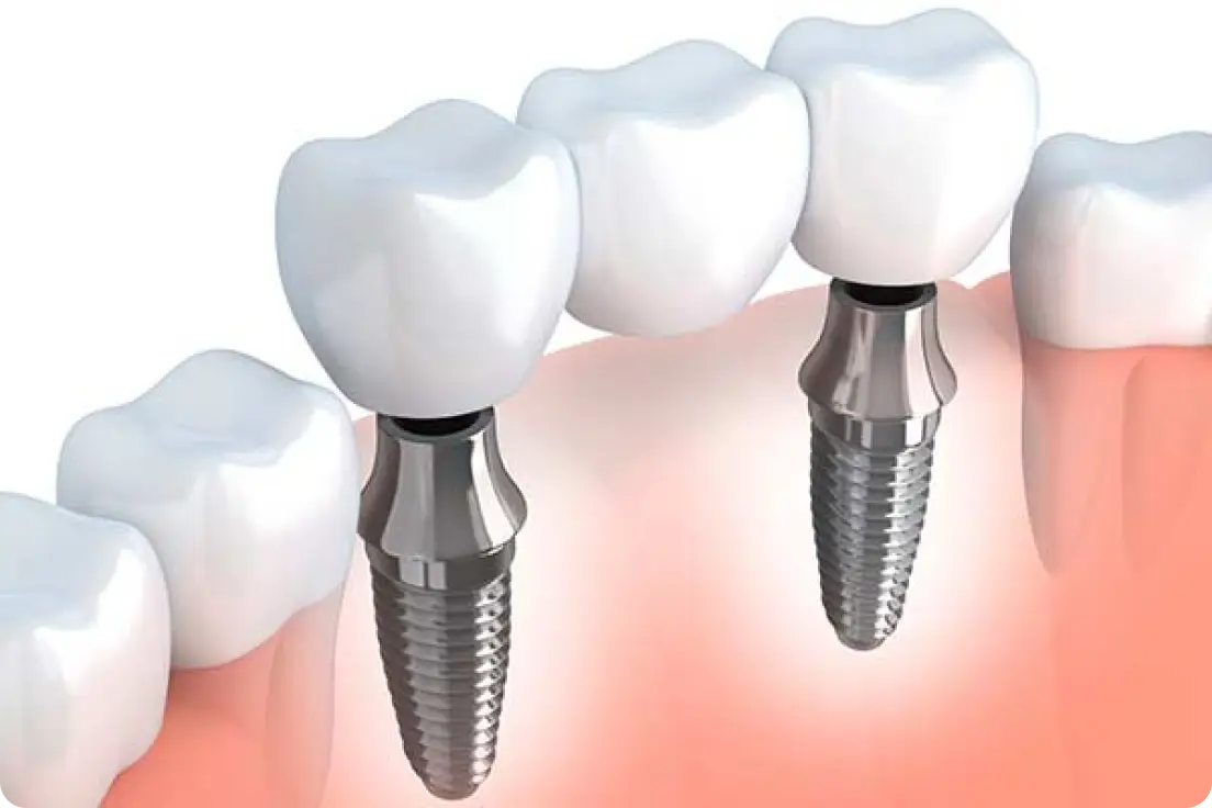 Why Choose a Bridge Supported by Dental Implants?