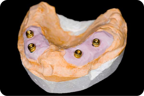 Replace a Full Set of Teeth with Just Four Implants